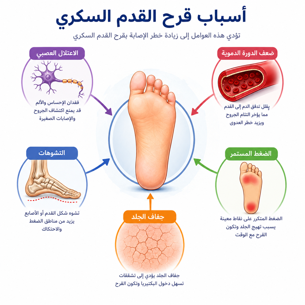 مخطط توضيحي لقرح القدم السكري